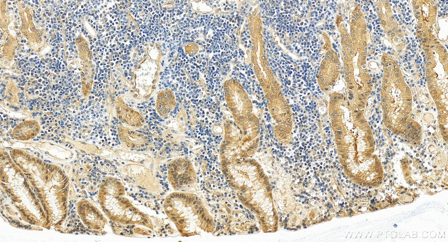 IHC staining of human stomach cancer using 82919-1-RR (same clone as 82919-1-PBS)