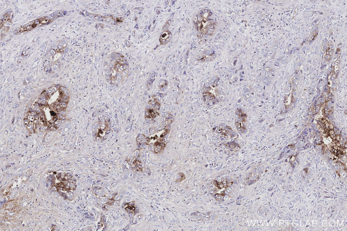 IHC staining of human pancreas cancer using 22024-1-AP IHC staining of human pancreas cancer using 22024-1-AP