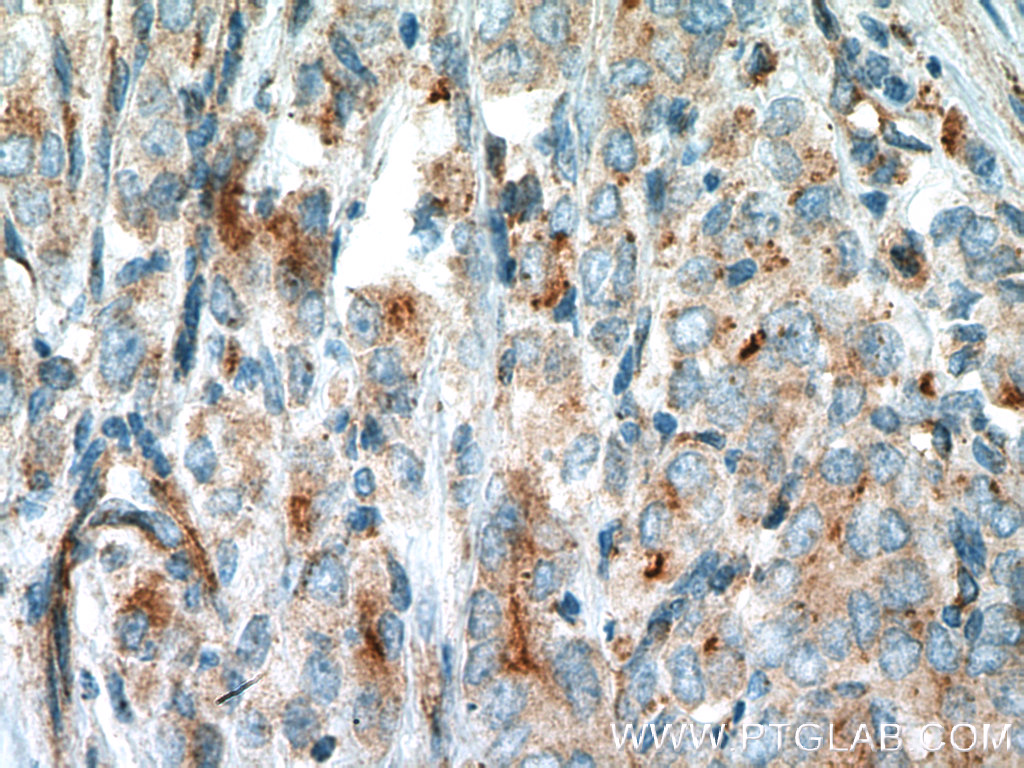 IHC staining of human prostate cancer using 12452-1-AP