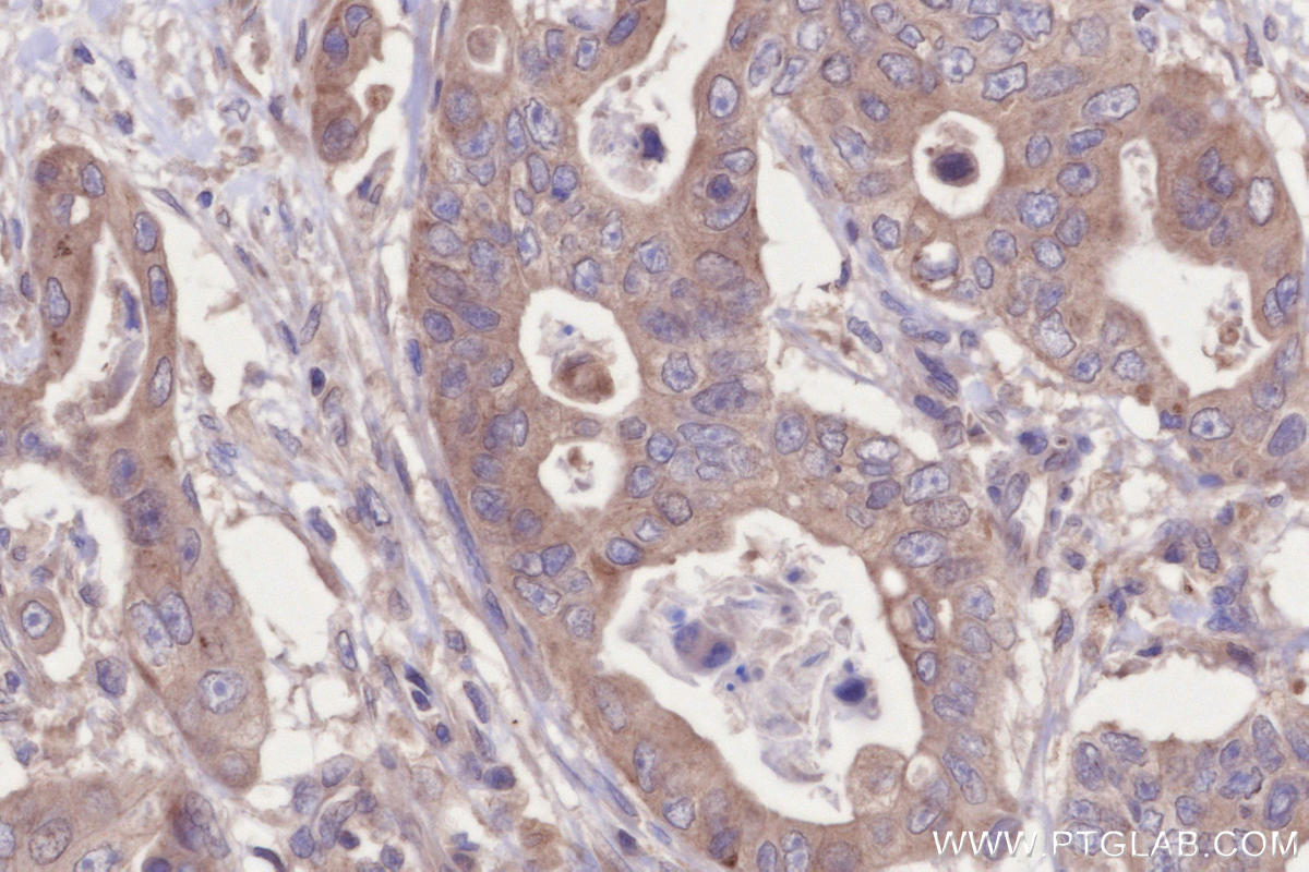 IHC staining of human stomach cancer using 13723-1-AP IHC staining of human stomach cancer using 13723-1-AP