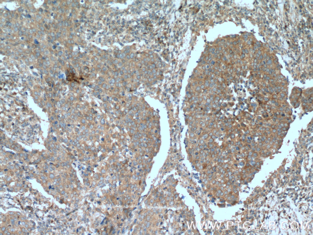 IHC staining of human lung cancer using 21890-1-AP