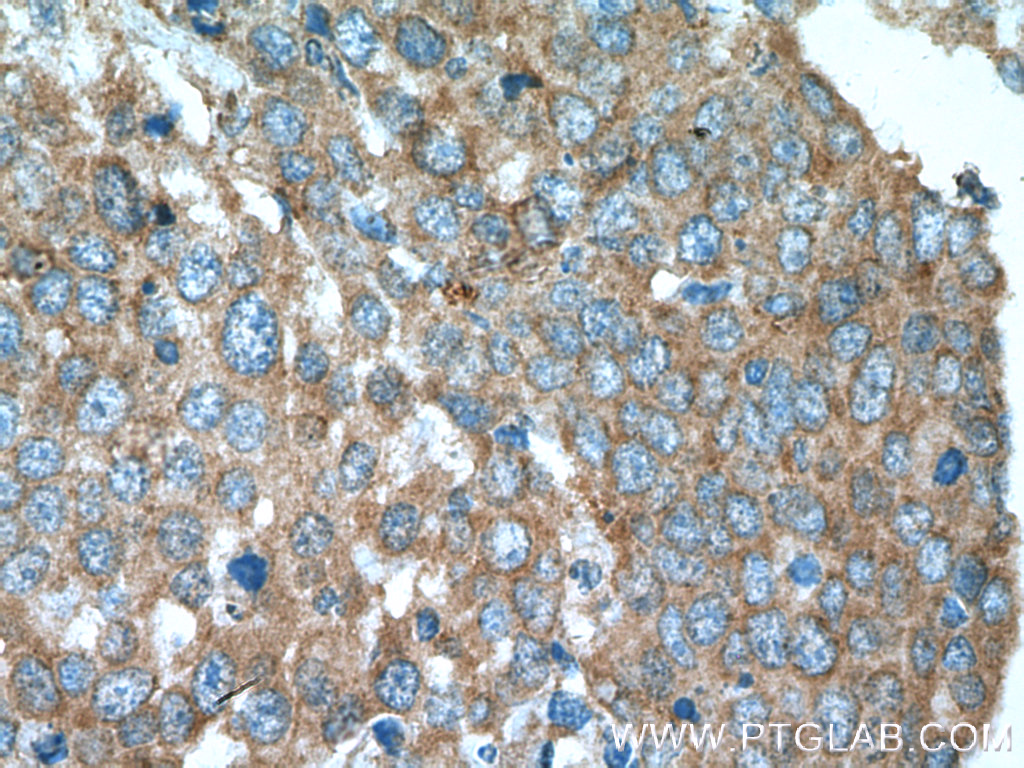 IHC staining of human lung cancer using 21890-1-AP