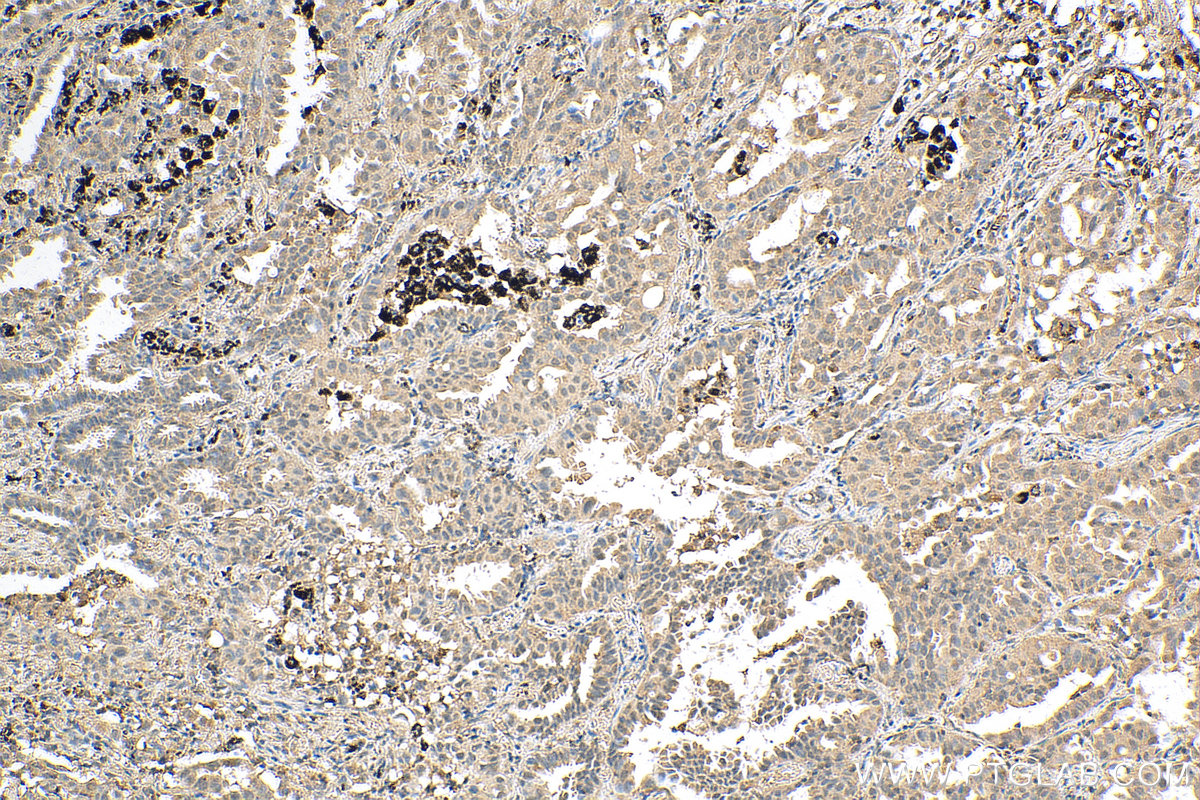 IHC staining of human lung cancer using 20584-1-AP