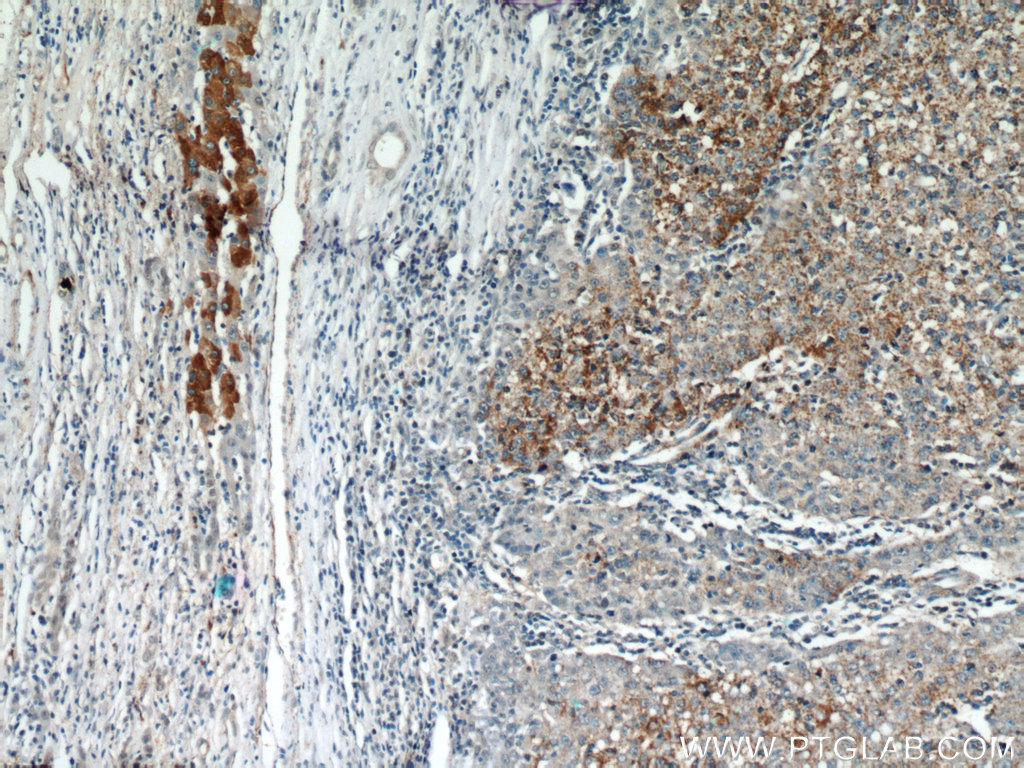 IHC staining of human liver cancer using 21739-1-AP