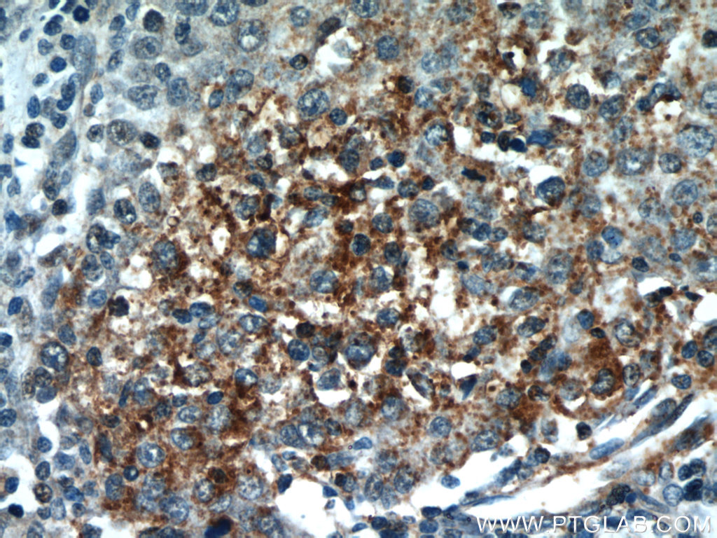 IHC staining of human liver cancer using 21739-1-AP