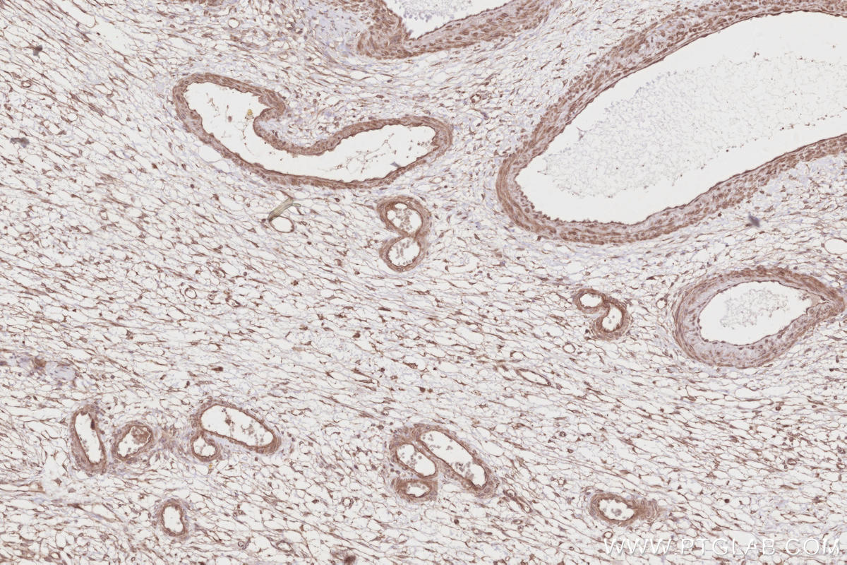IHC staining of human ovary cancer using 17894-1-AP IHC staining of human ovary cancer using 17894-1-AP