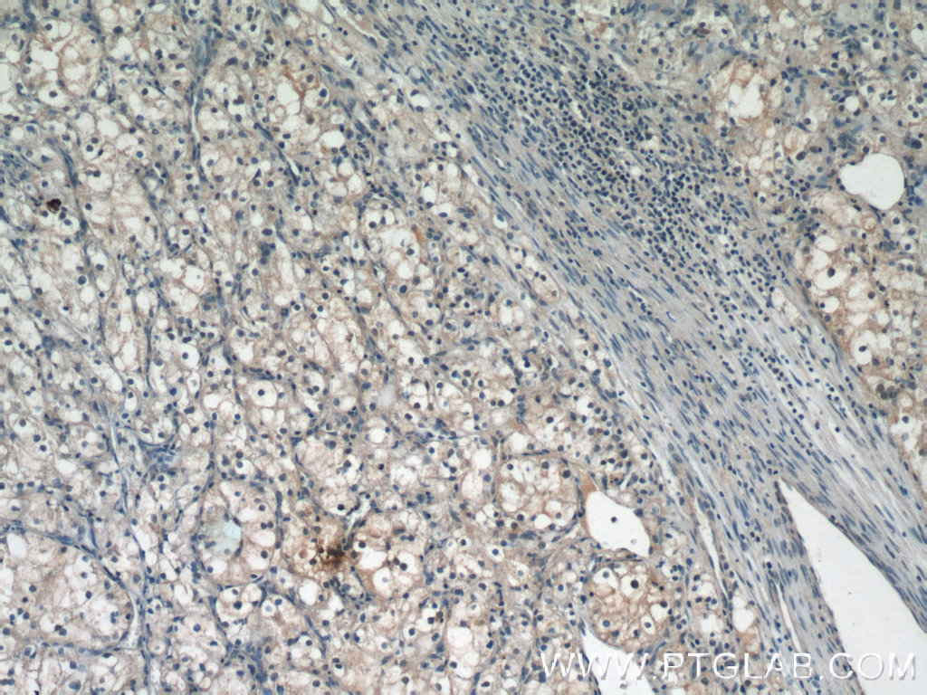 IHC staining of human renal cell carcinoma using 10495-1-AP