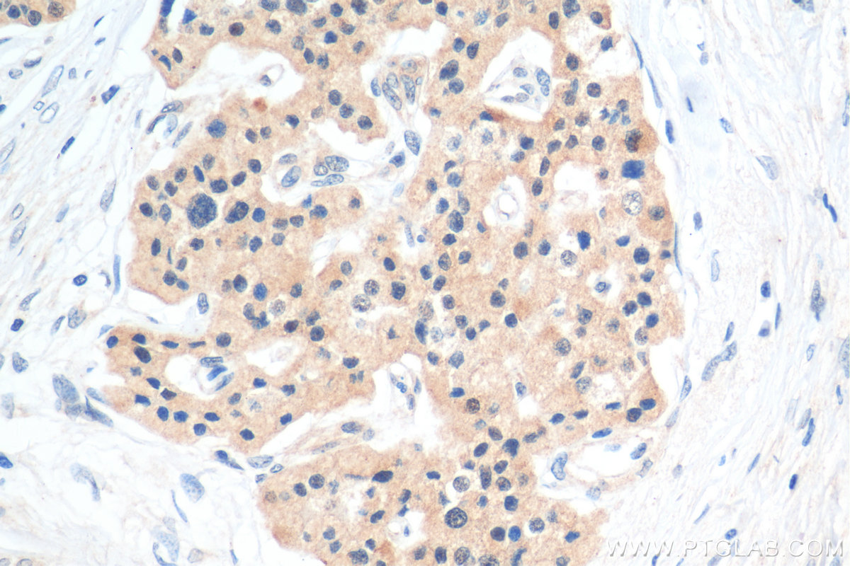 IHC staining of human pancreas cancer using 10495-1-AP