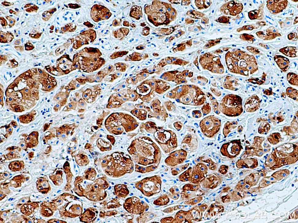 IHC staining of human breast cancer using 16068-1-AP