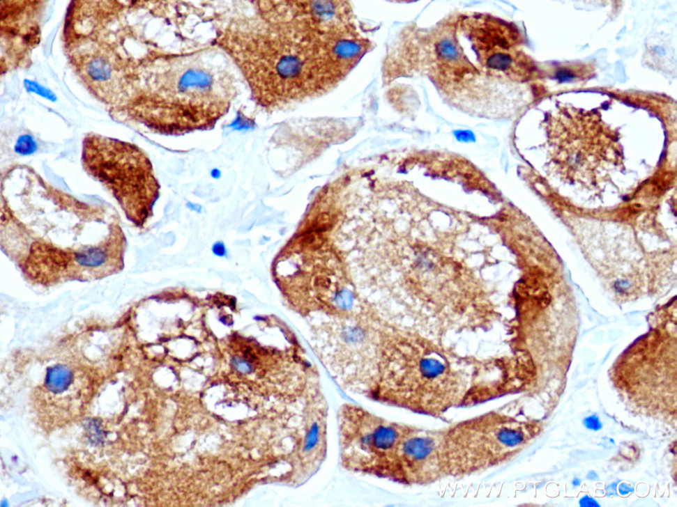 IHC staining of human breast cancer using 16068-1-AP