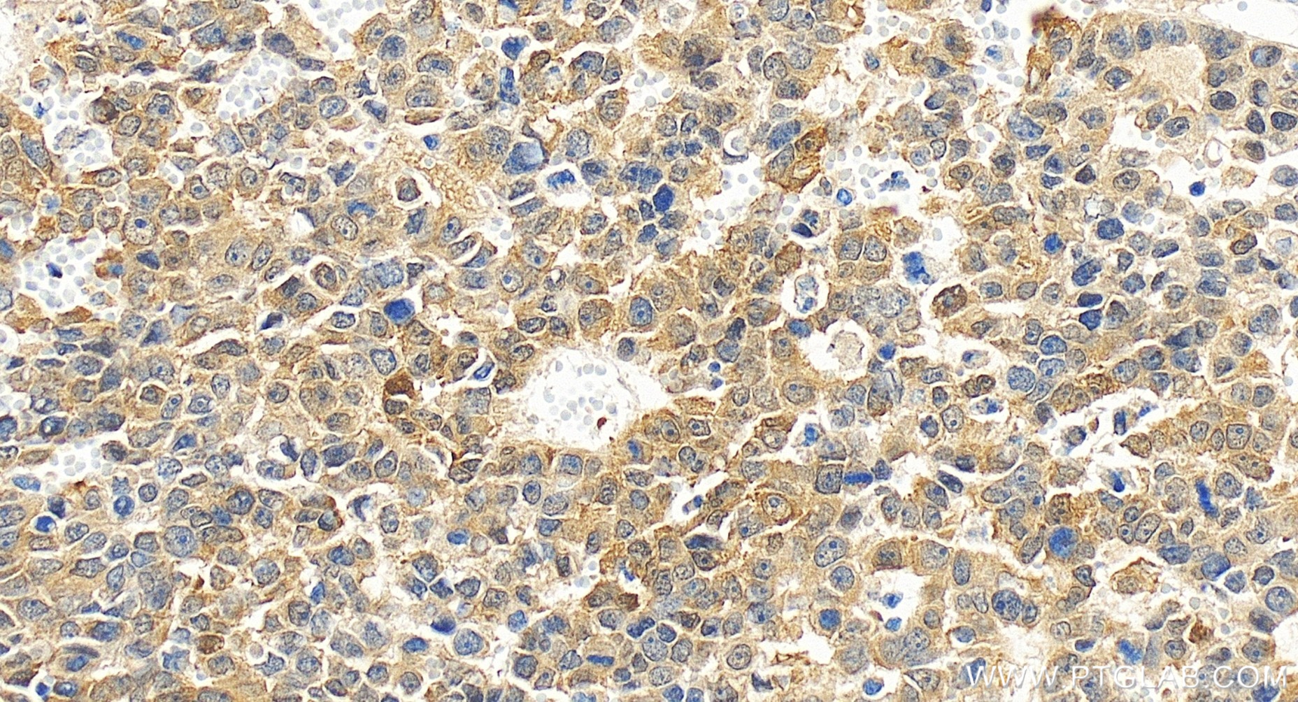 Immunohistochemical analysis of paraffin-embedded human liver cancer tissue slide using 85356-1-RR (PIP4K2C antibody) at dilution of 1:500 (under 40x lens). Heat mediated antigen retrieval with Tris-EDTA buffer (pH 9.0). IHC staining of human liver cancer using 85356-1-RR