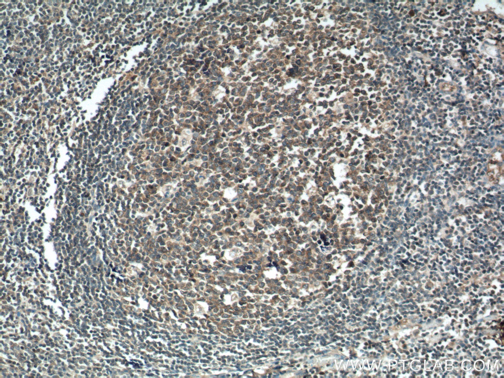 IHC staining of human tonsillitis using 15713-1-AP