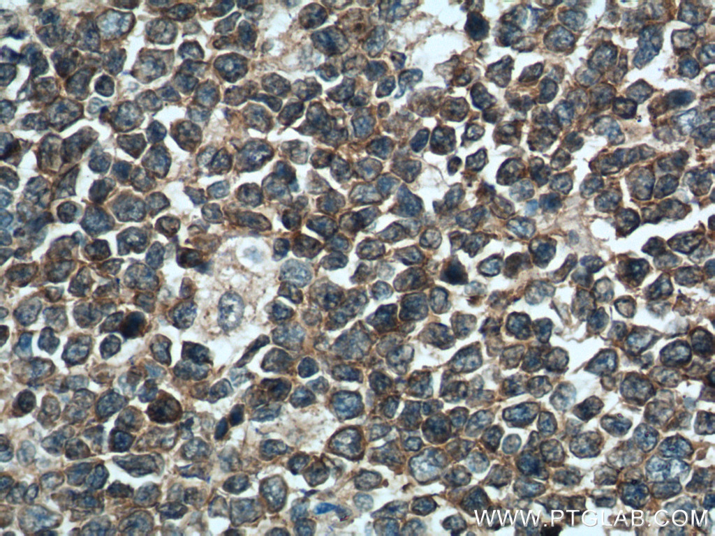 IHC staining of human tonsillitis using 15713-1-AP