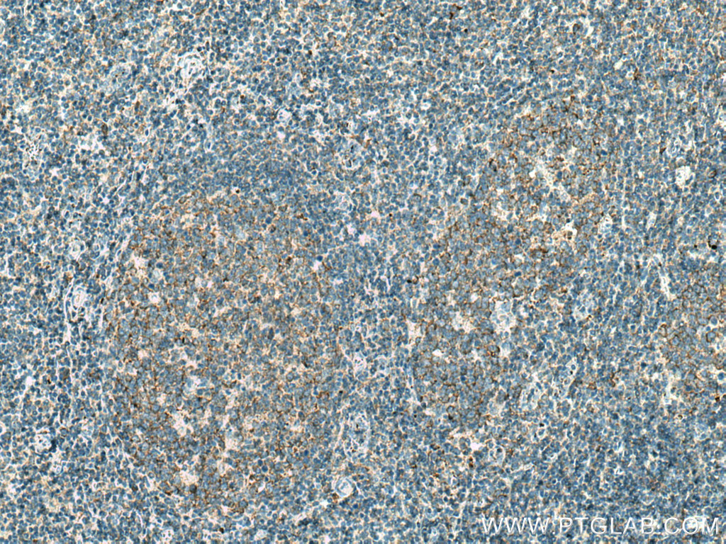 IHC staining of human tonsillitis using 67483-1-Ig (same clone as 67483-1-PBS)