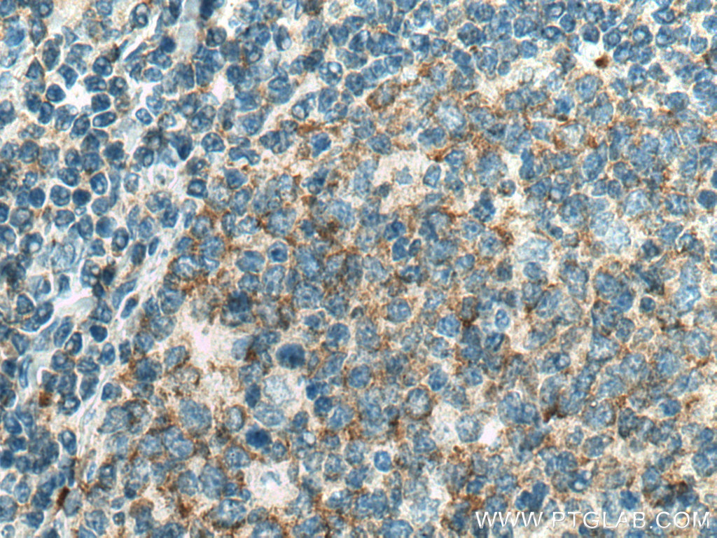 IHC staining of human tonsillitis using 67483-1-Ig (same clone as 67483-1-PBS)