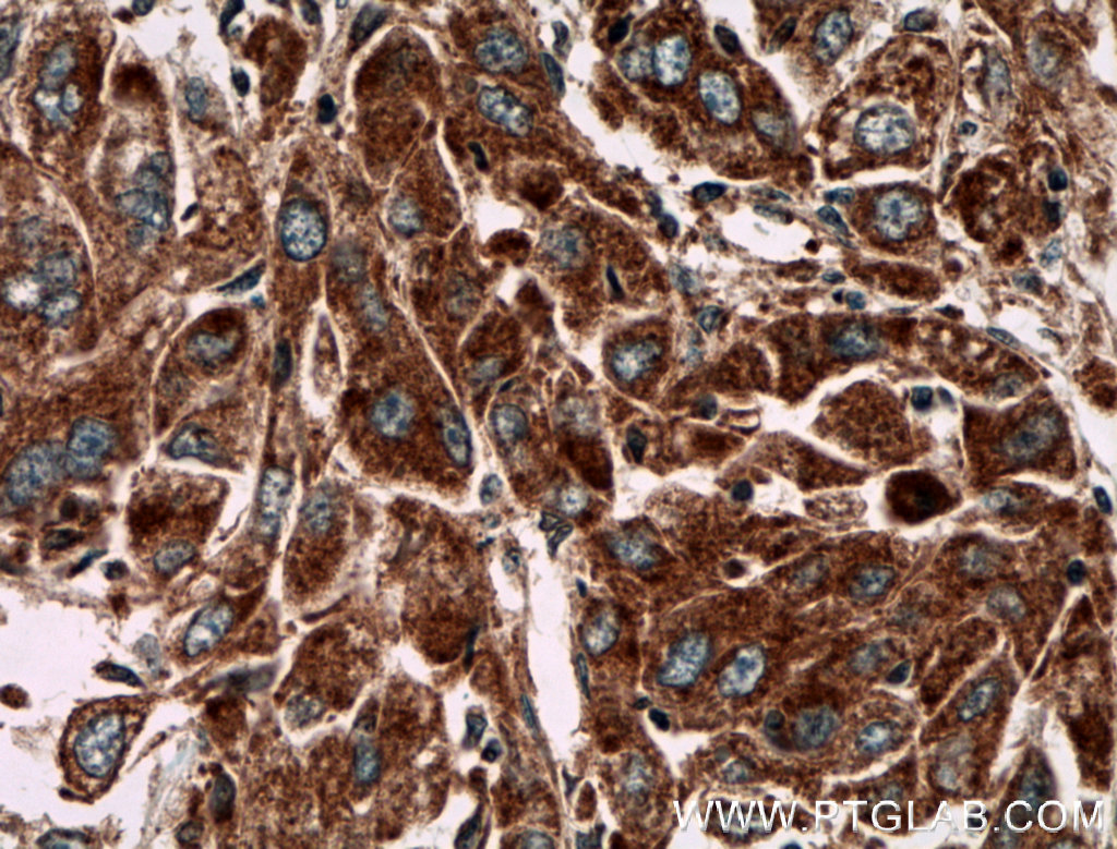 IHC staining of human liver cancer using 27640-1-AP