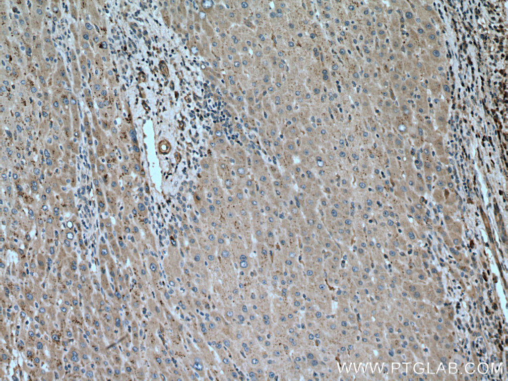 IHC staining of human liver cancer using 13361-1-AP