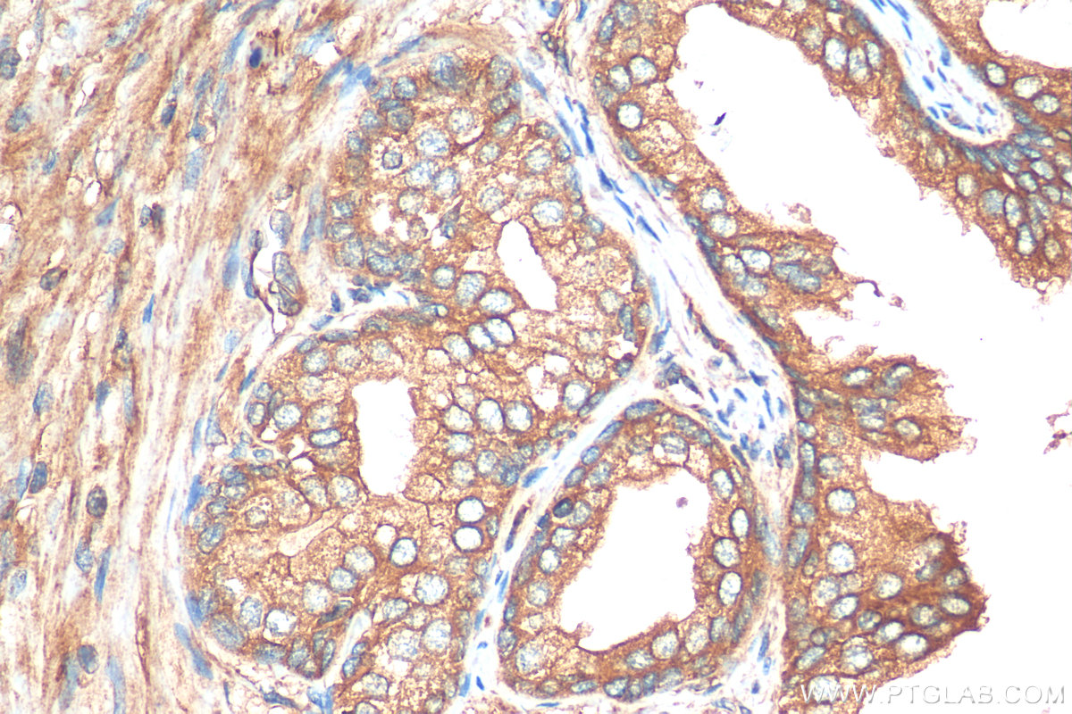 IHC staining of human prostate cancer using 13110-1-AP