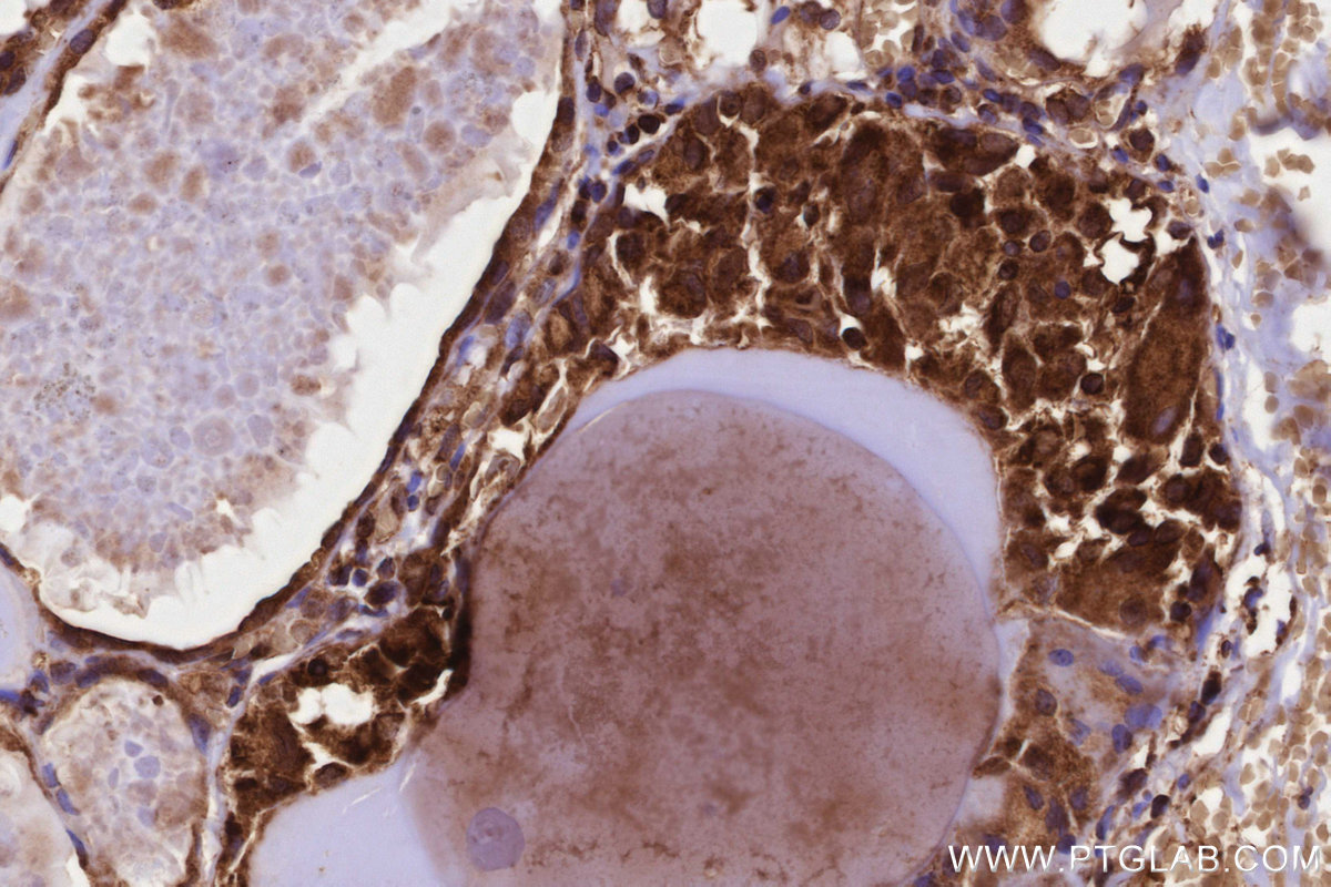 IHC staining of human thyroid cancer using 13110-1-AP