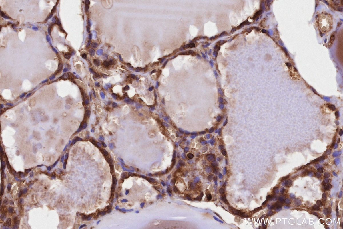 IHC staining of human thyroid cancer using 13110-1-AP