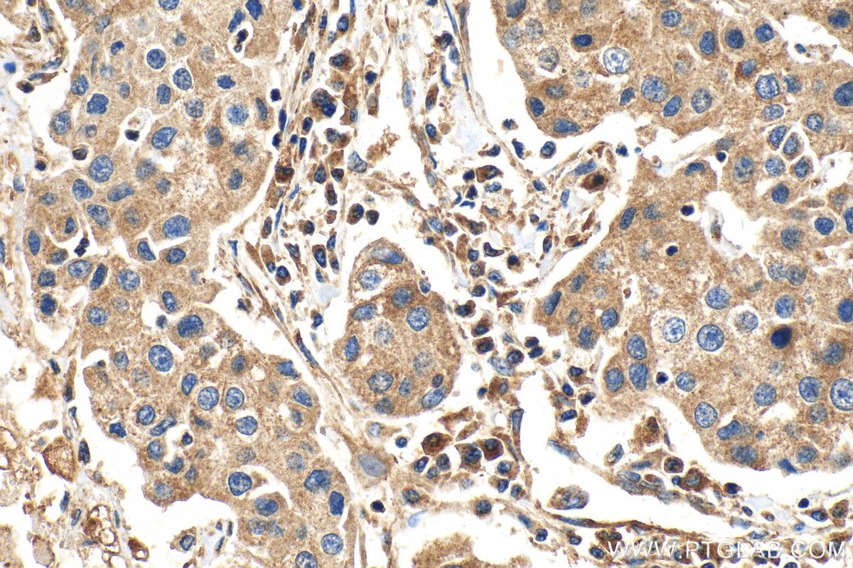 IHC staining of human breast cancer using 30674-1-AP