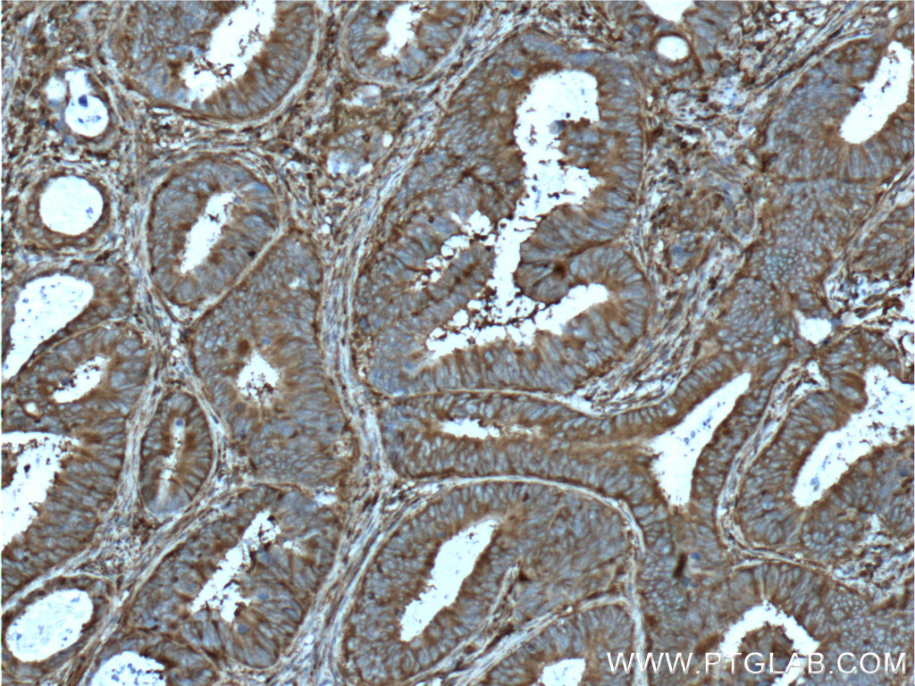 IHC staining of human colon cancer using 60268-1-Ig