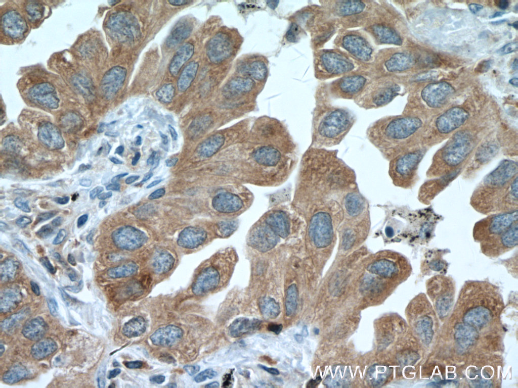 IHC staining of human lung cancer using 66421-1-Ig (same clone as 66421-1-PBS)