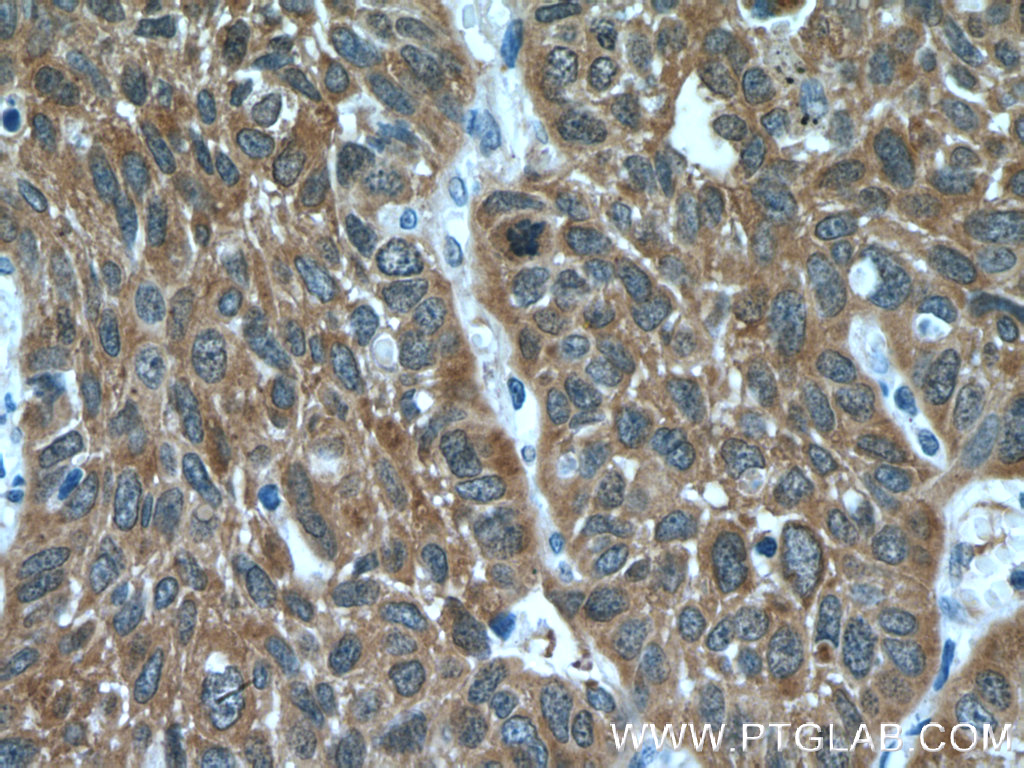 IHC staining of human lung cancer using 66493-1-Ig