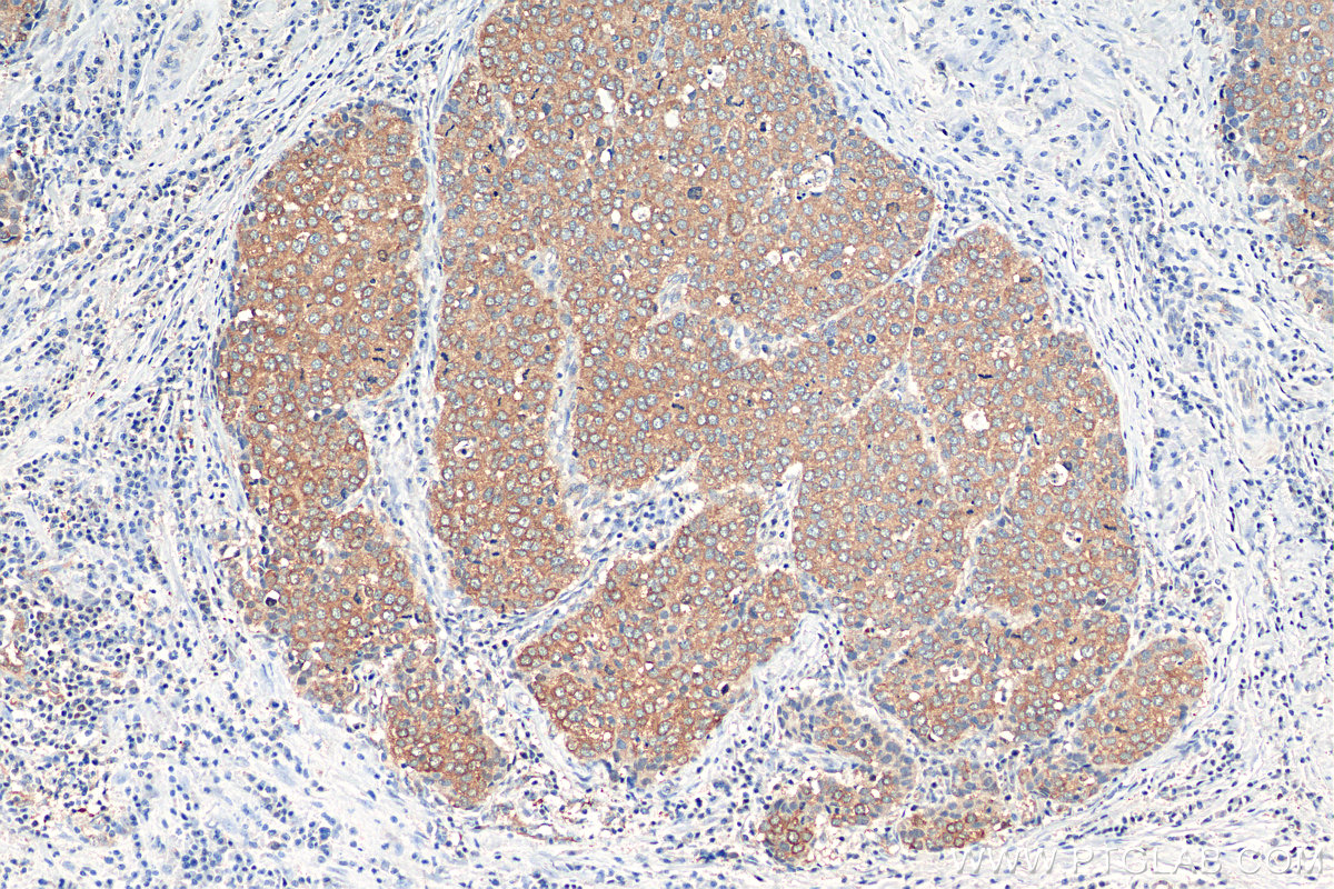 IHC staining of human stomach cancer using 11942-1-AP