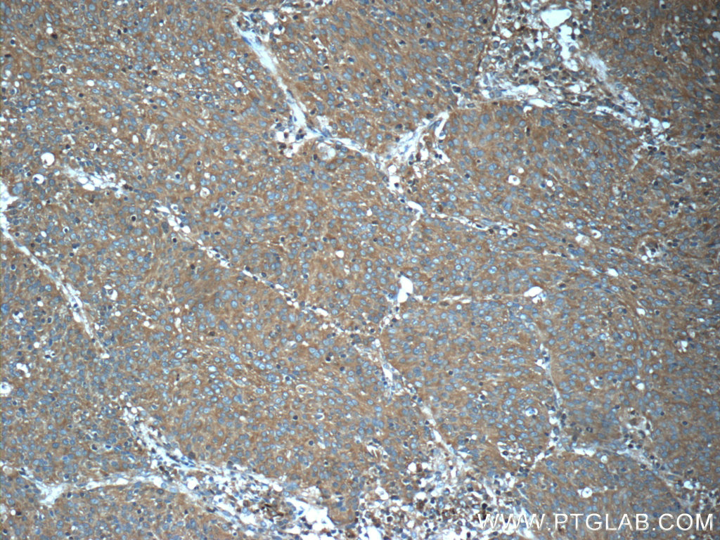 IHC staining of human lung cancer using 22456-1-AP