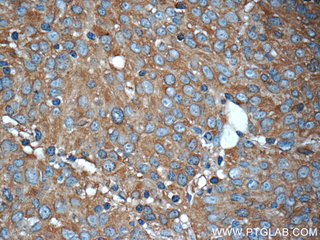 IHC staining of human lung cancer using 22456-1-AP