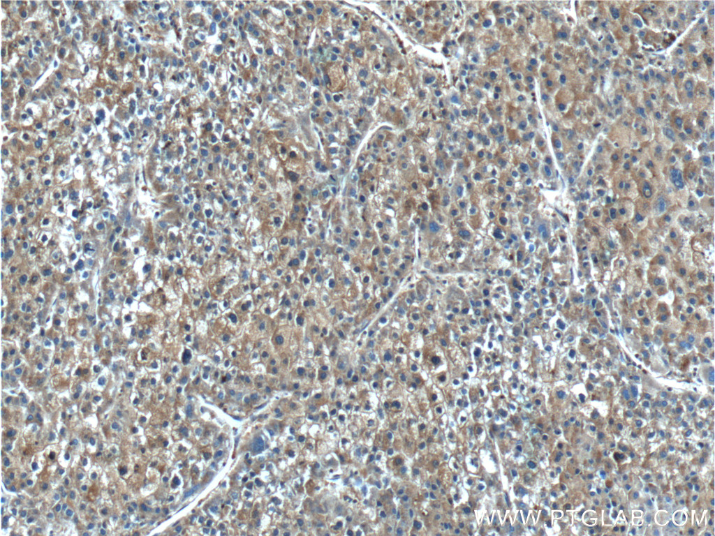 IHC staining of human liver cancer using 25659-1-AP
