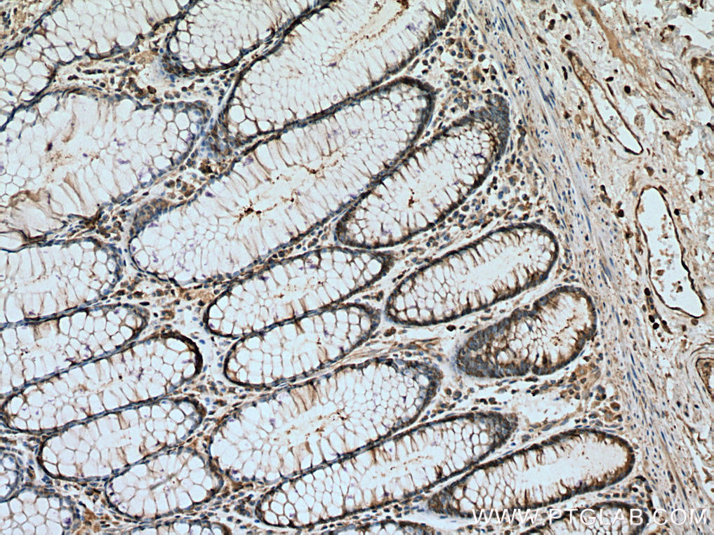 IHC staining of human colon cancer using 10078-2-AP