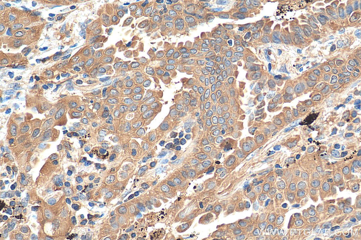 IHC staining of human lung cancer using 15822-1-AP