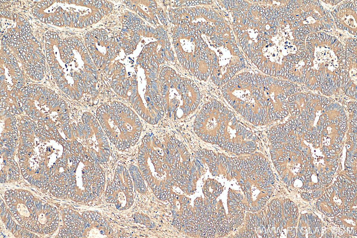 IHC staining of human colon cancer using 15822-1-AP