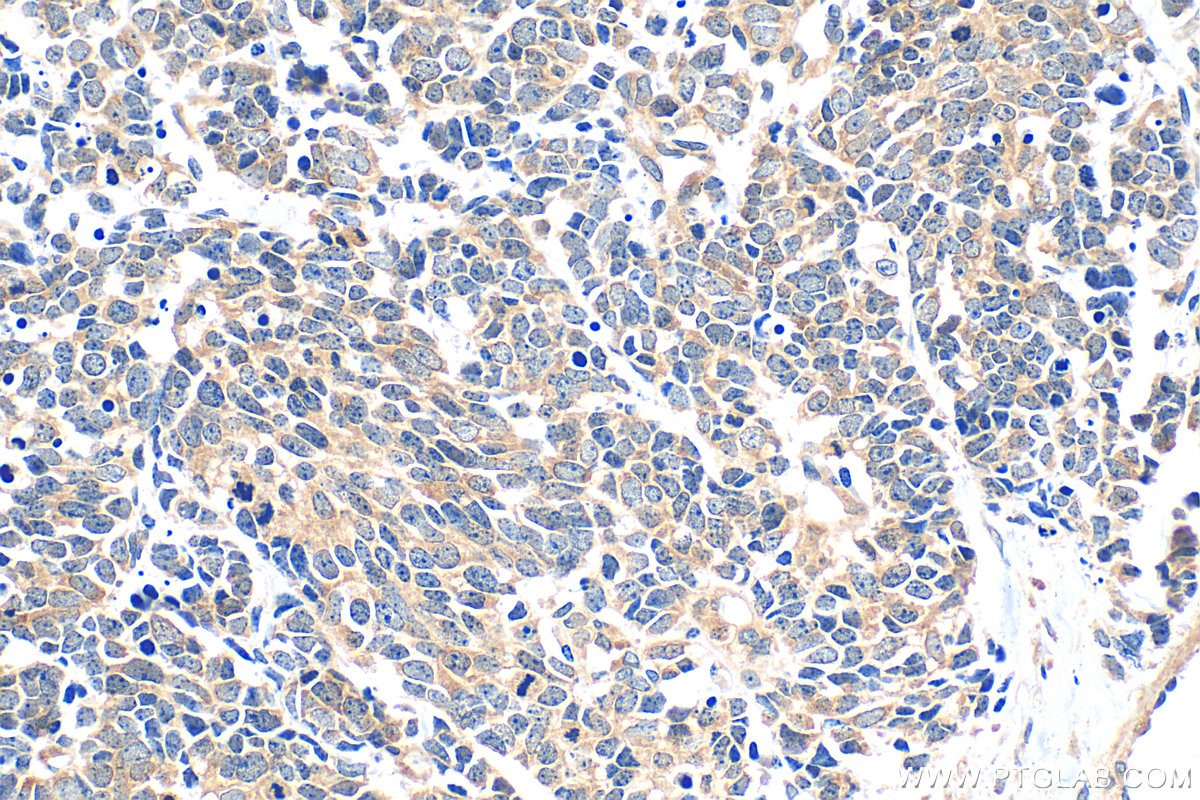Immunohistochemical analysis of paraffin-embedded human lung cancer tissue slide using 14608-1-AP (PKN2 antibody) at dilution of 1:500 (under 40x lens). Heat mediated antigen retrieval with Tris-EDTA buffer (pH 9.0). IHC staining of human lung cancer using 14608-1-AP