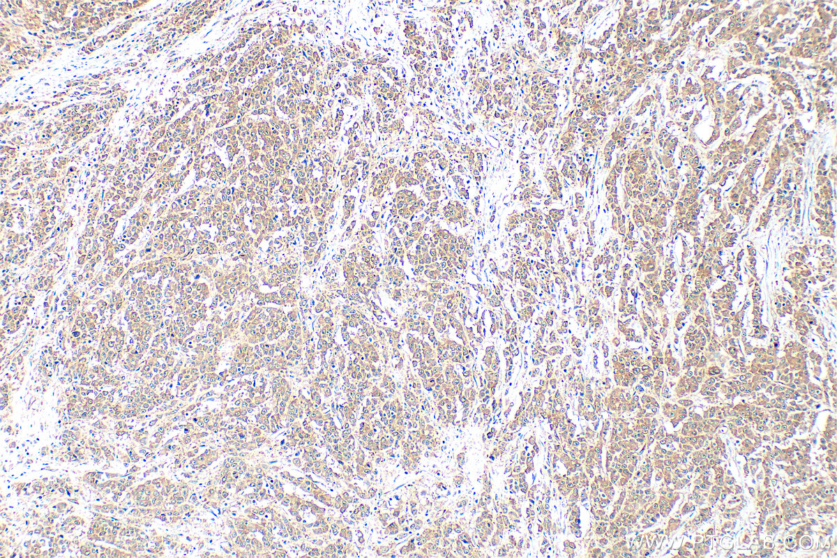 Immunohistochemical analysis of paraffin-embedded human colon cancer tissue slide using 14608-1-AP (PKN2 antibody) at dilution of 1:500 (under 10x lens). Heat mediated antigen retrieval with Tris-EDTA buffer (pH 9.0). IHC staining of human colon cancer using 14608-1-AP
