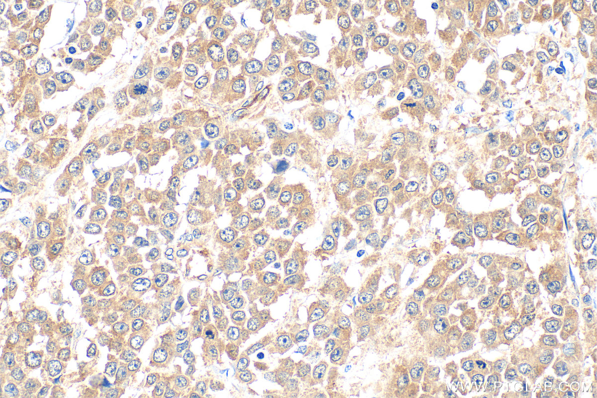 Immunohistochemical analysis of paraffin-embedded human colon cancer tissue slide using 14608-1-AP (PKN2 antibody) at dilution of 1:500 (under 40x lens). Heat mediated antigen retrieval with Tris-EDTA buffer (pH 9.0). IHC staining of human colon cancer using 14608-1-AP