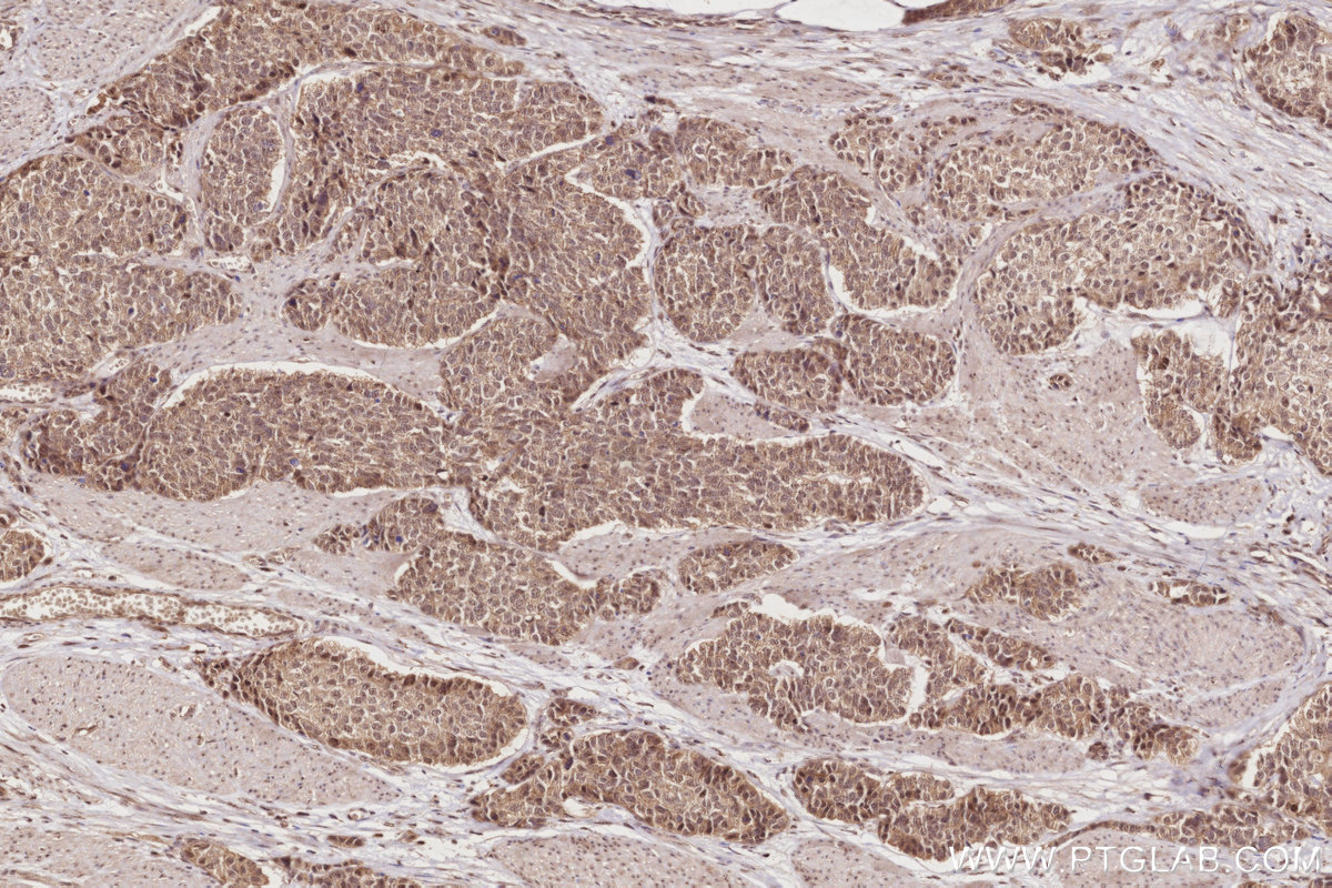 IHC staining of human stomach cancer using 14062-1-AP IHC staining of human stomach cancer using 14062-1-AP