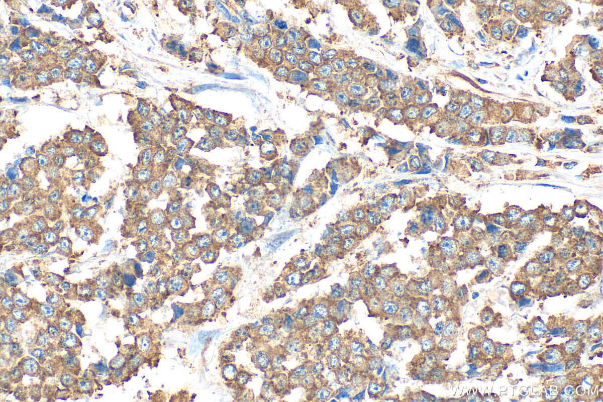 IHC staining of human colon cancer using 25799-1-AP