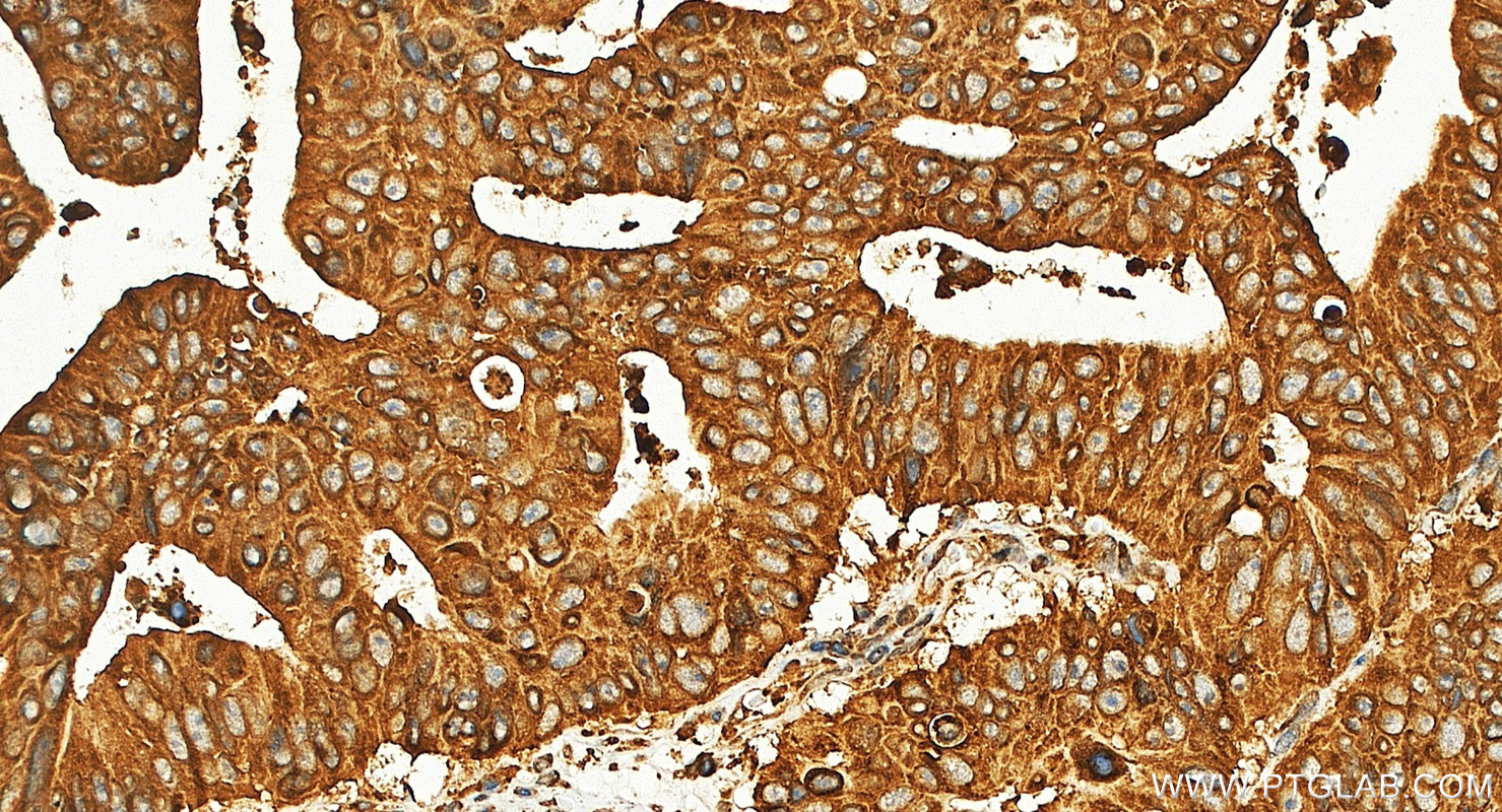 IHC staining of human colon cancer using 17646-1-AP