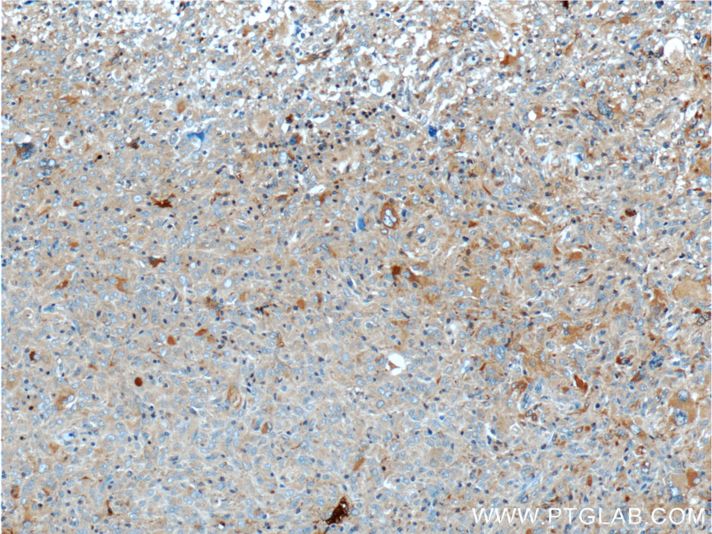 IHC staining of human gliomas using 55074-1-AP