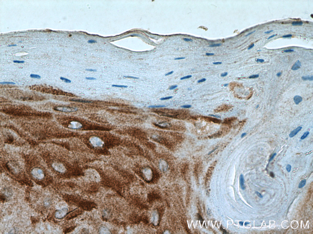 IHC staining of human skin cancer using 13345-1-AP