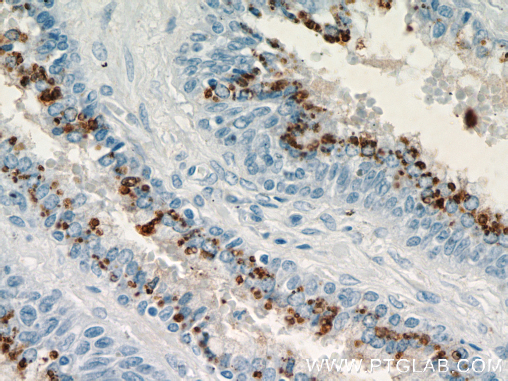 IHC staining of human prostate hyperplasia using 21411-1-AP