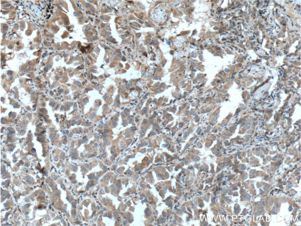 IHC staining of human lung cancer using 12529-1-AP (same clone as 12529-1-PBS)