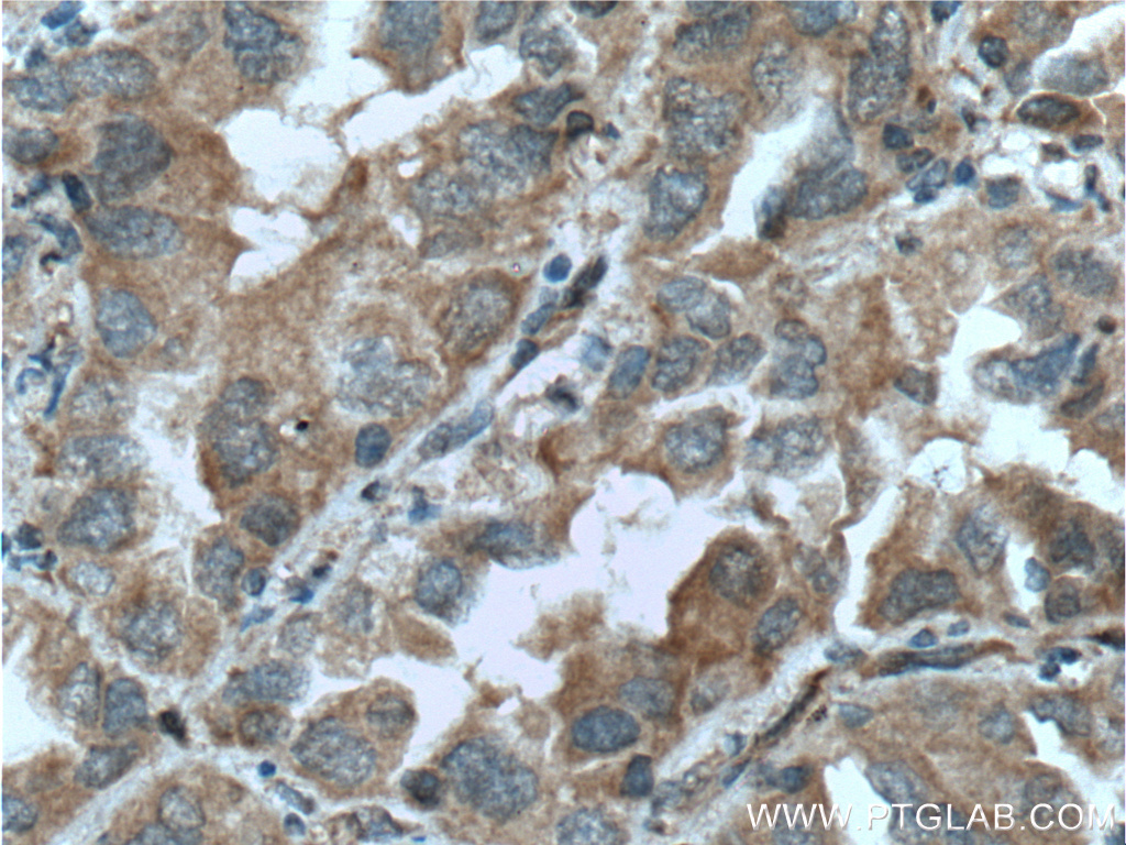 IHC staining of human lung cancer using 12529-1-AP (same clone as 12529-1-PBS)