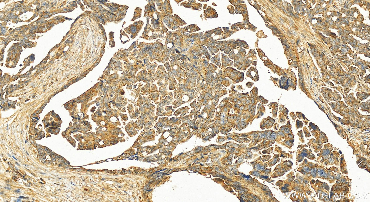 IHC staining of human ovary cancer using 17343-1-AP