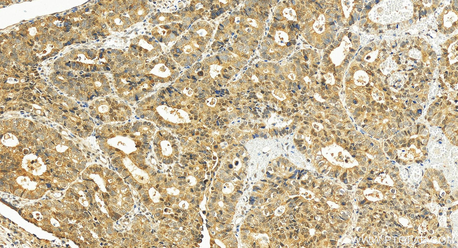 IHC staining of human stomach cancer using 25864-1-AP
