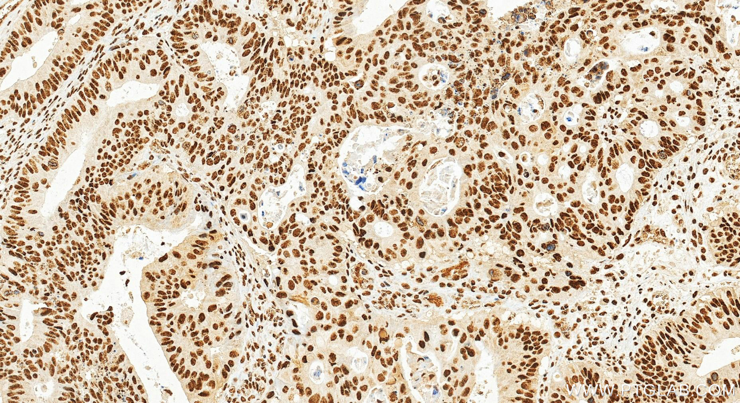 Immunohistochemical analysis of paraffin-embedded human colon cancer tissue slide using 68606-1-Ig (PLAGL2 antibody) at dilution of 1:500 (under 20x lens). Heat mediated antigen retrieval with Tris-EDTA buffer (pH 9.0). IHC staining of human colon cancer using 68606-1-Ig