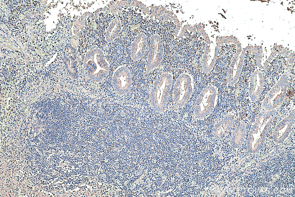 IHC staining of human appendicitis using 60294-1-Ig